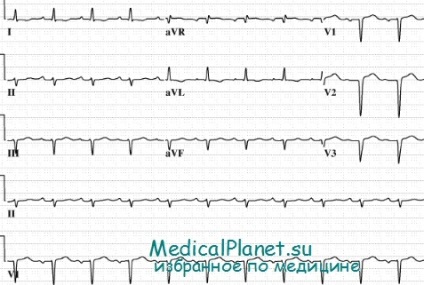 Efectul travaliului asupra ecg în cazul bolii hipertensive