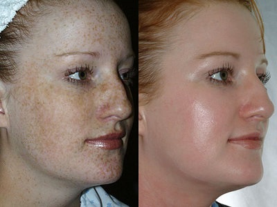 Chemical Peel Reviews