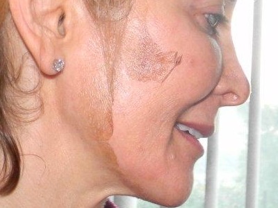 Chemical Peel Reviews