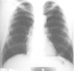 Chondroma site-ul pulmonar al unui radiolog practică - roentgenologie, radiografie, diagnosticul radiațiilor