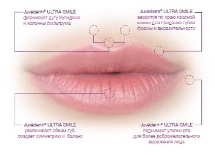 Juvederm (juvederm) este una dintre primele preparate pe bază de acid hialuronic