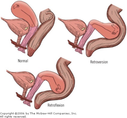 Îndoirea uterului