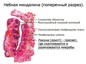 Este amigdala infecțioasă ca inflamație acută sau cronică?