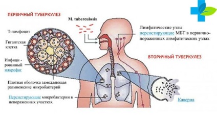 Este tuberculoza contagioasă?