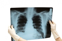 Este tuberculoza pulmonară contagioasă?