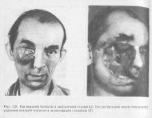 Neoplasm malign de maxilare, stomatologie terapeutică
