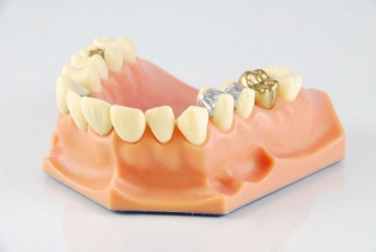 Coroanele de aur pe dinți seamănă cu ele, se prezintă, se îndepărtează și se curăță