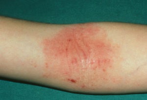 Mâncărime la dermatită atopică a formei de manifestare, tratament