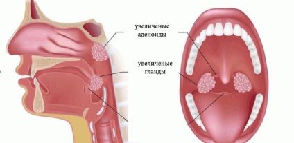 Adenoizii și glandele care sunt cei care intervin și ce să facă cu ei