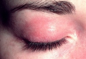 Alergia la simptomele oculare ale pleoapelor, cauze, tratament, prevenire (cu video)