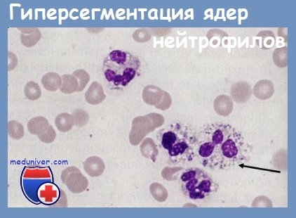 Anomalii ale leucocitelor - clasificare, specii