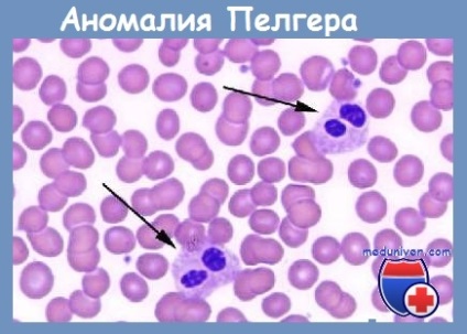 Anomalii ale leucocitelor - clasificare, specii