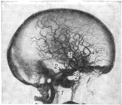 Anastomozele arterio-sinusale