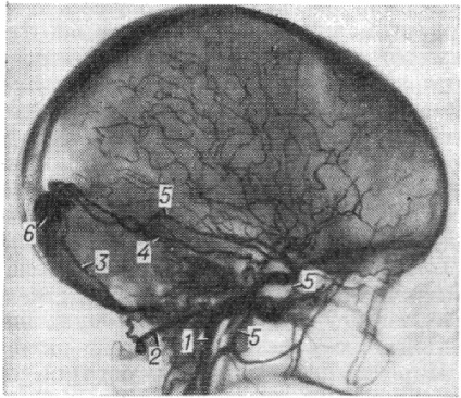 Anastomozele arterio-sinusale