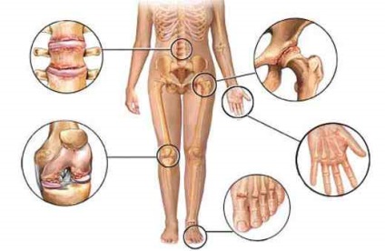 Osteoartrita - simptome, tratament, prognostic
