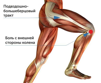 Genunchiul doare atunci când se execută pe partea laterală (sindromul tractului ileal-tibial)