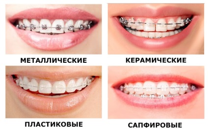 Bretele din Nižni Novgorod - prețul de bretele pentru dinți
