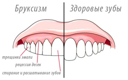 A bruxizmus a fogak csiszolása