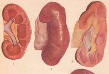 Calyx patologie rinichi, funcție, tratament
