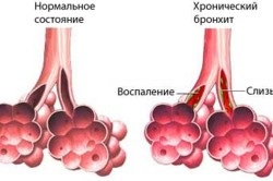 Mai degrabă decât pentru a trata o bronșită cronică