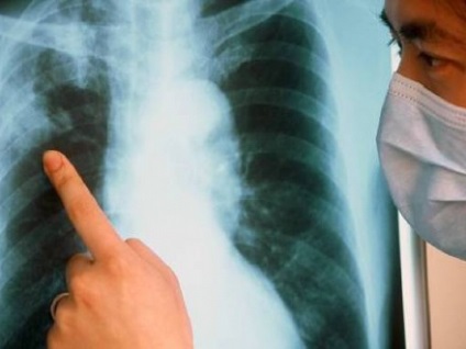Care este pericolul tuberculozei pe scurt?