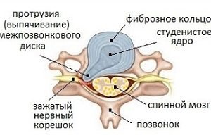 Care este proeminența paramedială a discului intervertebral