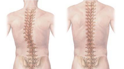 Mi a scoliosis (scoliosis) Mi a scoliosis?