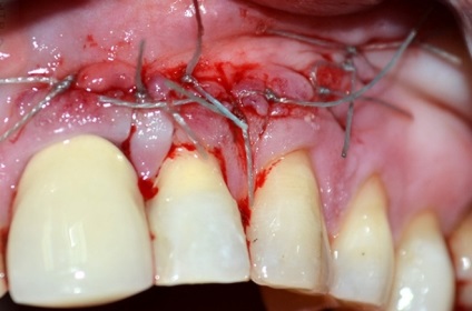 Cistectomia dintelui este ceea ce este, atunci când este făcut, de ce