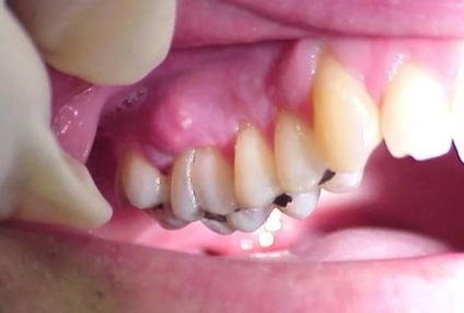 Cistectomia dintelui este ceea ce este, atunci când este făcut, de ce