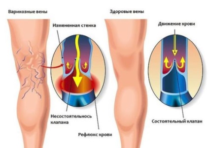 A vascularis csillagok szeretnek tiszta fájdalom és műtét, egészség és gyógyszer nélkül