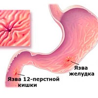 Simptome duodenogastrice de reflux, dietă și tratament