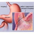 Simptome duodenogastrice de reflux, dietă și tratament