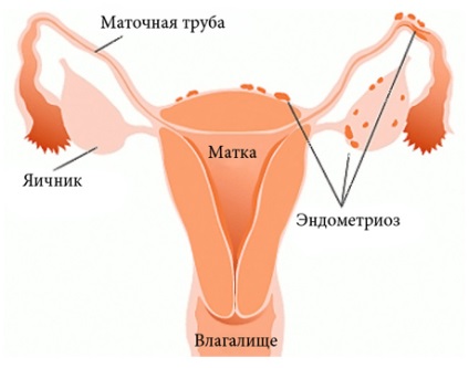 Endometrioza simptome, tratament, eurolab, ginecologie