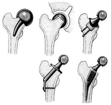 Endoproteticele suprafețelor articulare - endoprotetice, endoprotetice ale șoldului