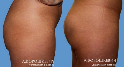 A fenék endoprotetikája Moszkvában, kritikák és fotók