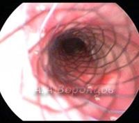 Endotracheális technika - stadopedia