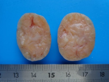 Fibromul diagnosticului mamar și metodele de bază ale tratamentului