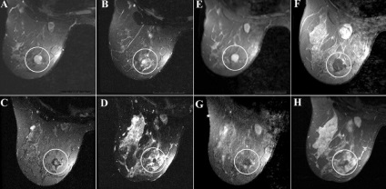 Fibromul diagnosticului mamar și metodele de bază ale tratamentului