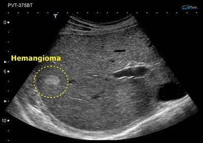 Hemangiomul hepatic