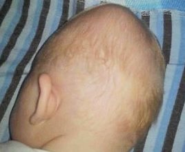 Az újszülöttek fejében hematoma okoz és következményei