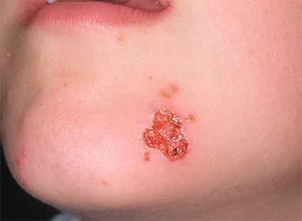 Herpesz az arcon okoz, tüneteket és kezelést a bőrből
