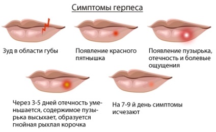 Herpesul pe față produce, simptomele și tratamentul din piele