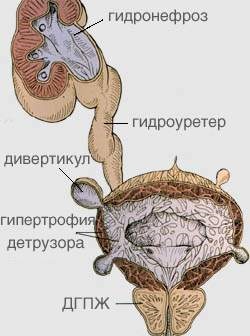 Hydronephrosis, boli urologice