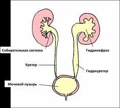 Hydronephrosis, boli urologice