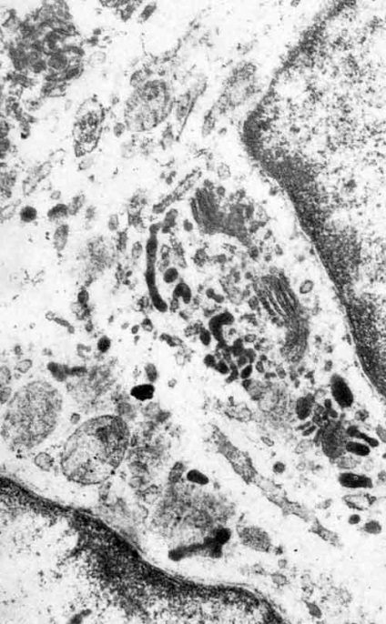 Histiocite hipertrofice - modificări celulare asociate cu inflamatorii și altele