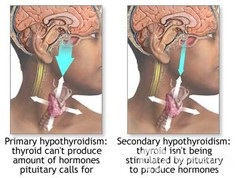 Hipotiroidismul - simptome, tratament, prognostic