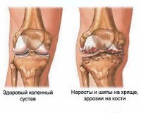 Gonartroza - cauze, simptome, diagnostic și tratament