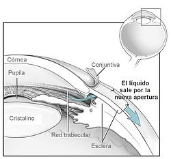 Lentilă artificială