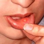 Melyik orvos kezeli a szájgyulladást gyermekekben és felnőttekben?