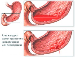 Cum să vindeci un ulcer de stomac în Ayurveda
